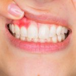 Zakaj najpogosteje prihaja do vnetja dlesni