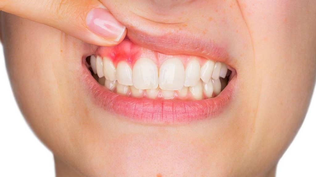 simptomi za vnete dlesni