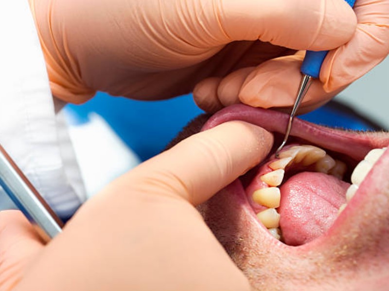 Ljudje zobozdravnika navadno obiščemo šele, ko opazimo simptome za vnete dlesni.