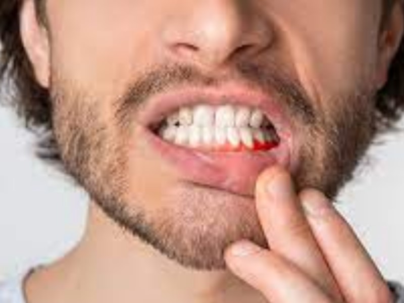 Zobozdrvnik bo odločil ali je potrebno temeljito zdravljenje zob.