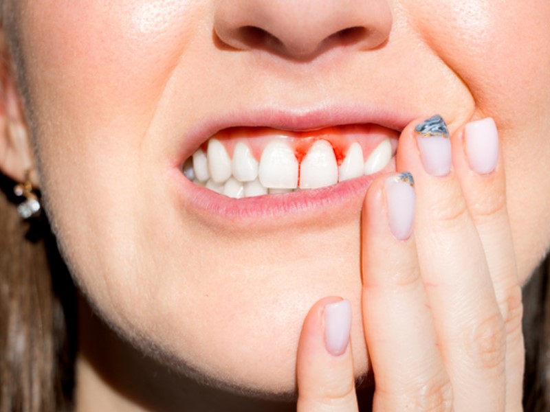 Med očitne simptome za vnete dlesni spada krvavenje iz dlesni.